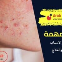 حب الشباب الاسباب والاعراض والعلاج