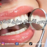أسباب تسوس الأسنان وطرق العلاج والوقاية